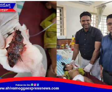 ಮೀನು ನುಂಗಿದ 11 ತಿಂಗಳ ಮಗು ! ಮರು ಜನ್ಮ ನೀಡಿದ ಸರ್ಜಿ ಆಸ್ಪತ್ರೆಯ ವೈದ್ಯರು ! ಪ್ರಾಣಪಾಯದಿಂದ ಮಗು ಪಾರು ! ಏನಿದು ಘಟನೆ ?